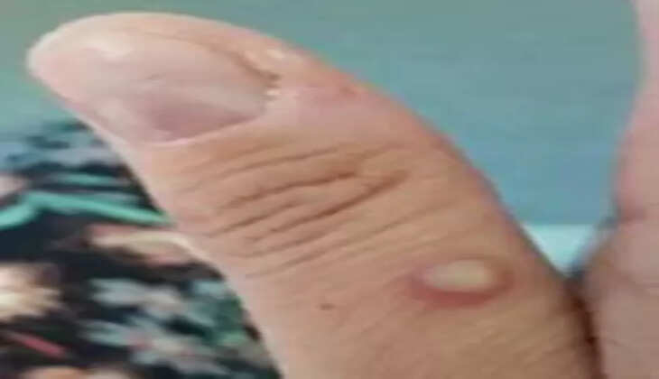 विश्व स्वास्थ्य नेटवर्क ने मंकीपॉक्स के प्रकोप को महामारी घोषित किया