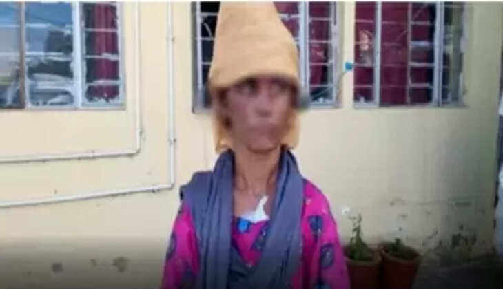 ससुराल वाले बने हैवान, गर्म तवे से बहू को जलाया, पीड़िता अस्पताल में भर्ती