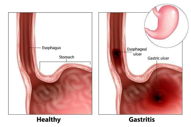 क्या है गैस्ट्राइटिस और कैसे करें इसका उपचार, आइये जानते है डा. संजय जोशी से पूरी जानकारी