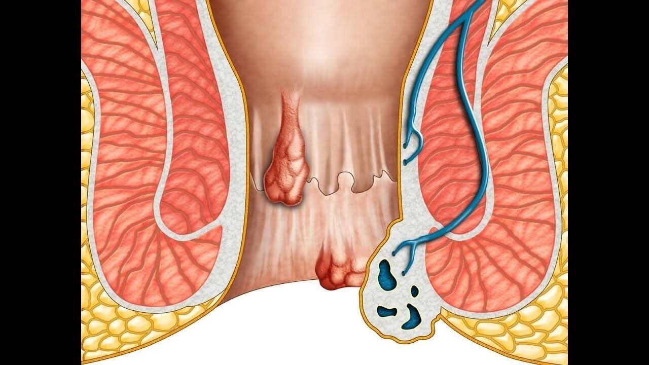 अब बवासीर और भगन्दर की बीमारी का होगा खात्मा, डा. संजय जोशी इस विधि से कर रहे उपचार