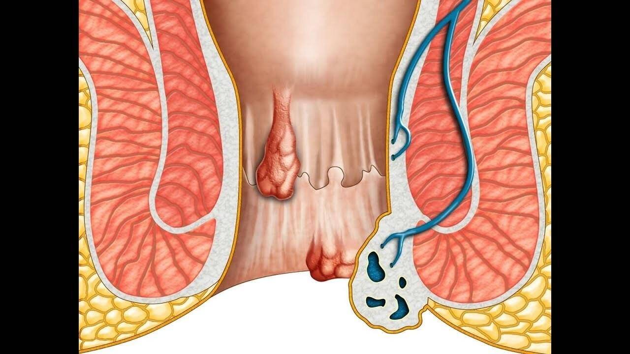 अब बवासीर और भगन्दर की बीमारी का होगा खात्मा, डा. संजय जोशी इस विधि से कर रहे उपचार