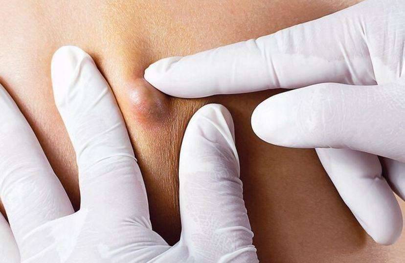 होम्योपैथिक विधि से पायें स्तन की गांठ से छुटकारा, पढिय़े डॉ. एनसी पाण्डेय के टिप्स